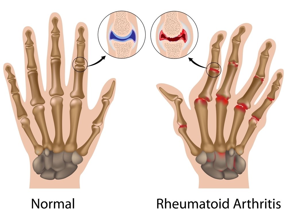 Therapy for Rheumatoid Arthritis in the Hand