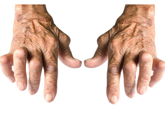 Rheumatoid Arthritis