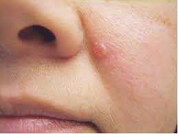 skin cancer
